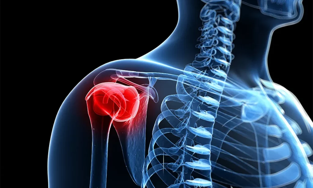 Understanding Shoulder Impingement