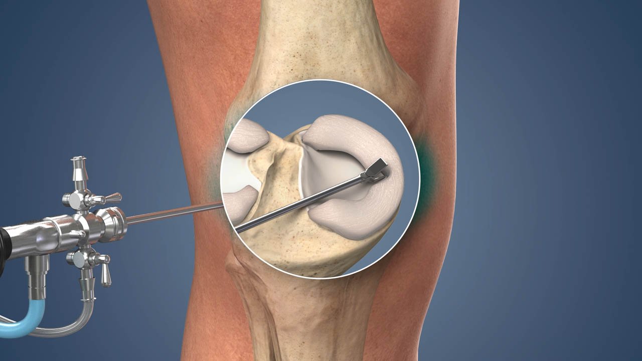 Meniscus Injuries