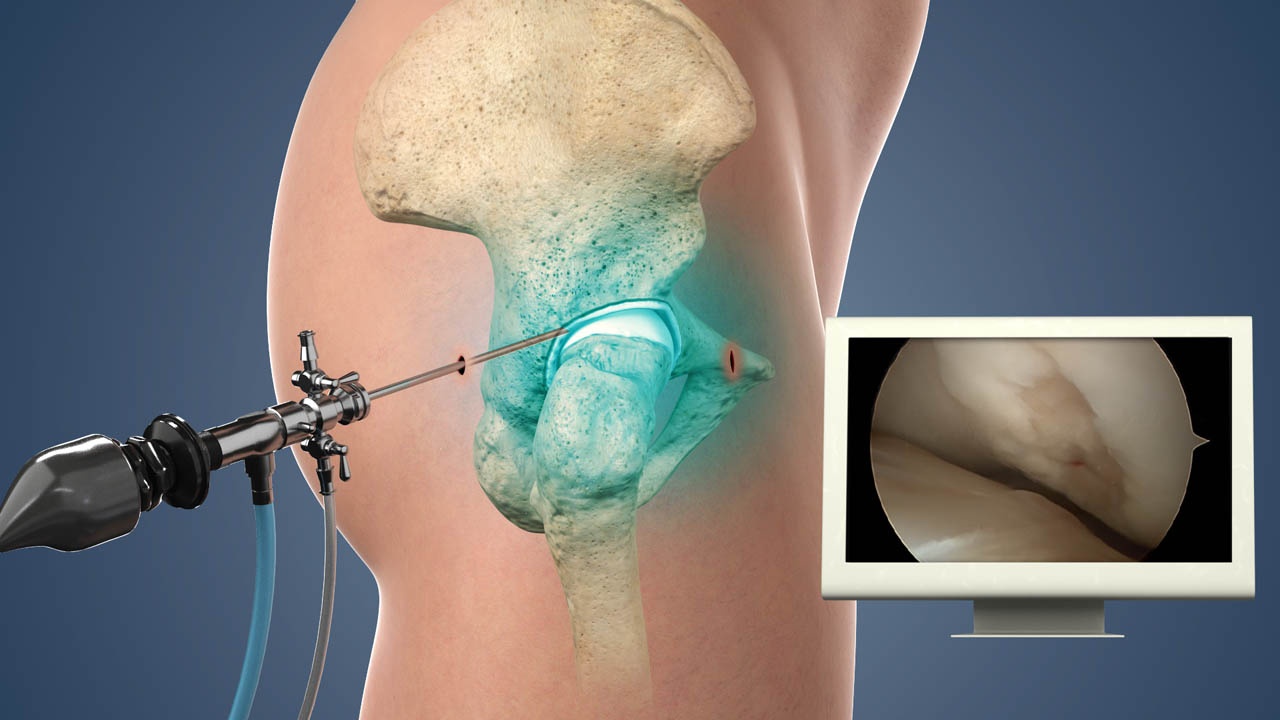 Labral Tear Repair