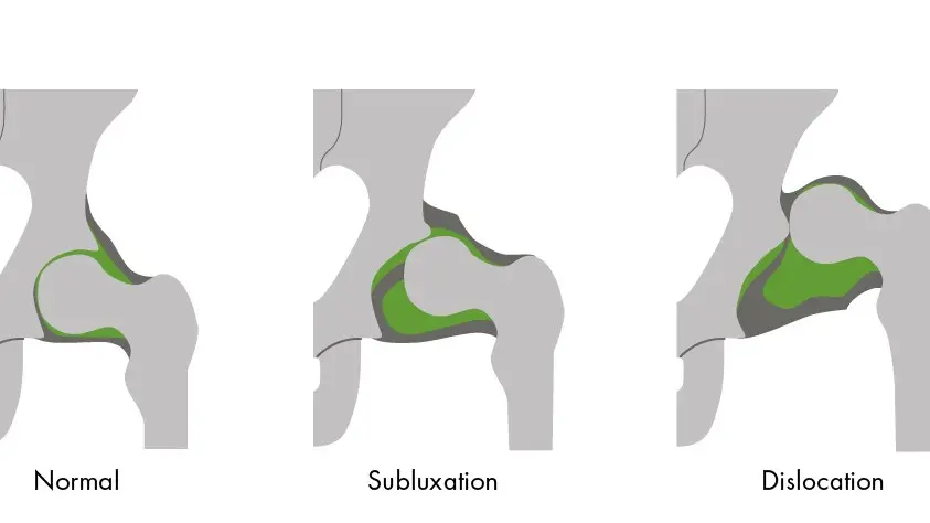 Hip Dislocation Types