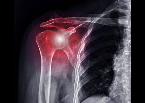 Rotator Cuff Anatomy
