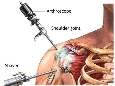 Rotator Cuff Repair 1