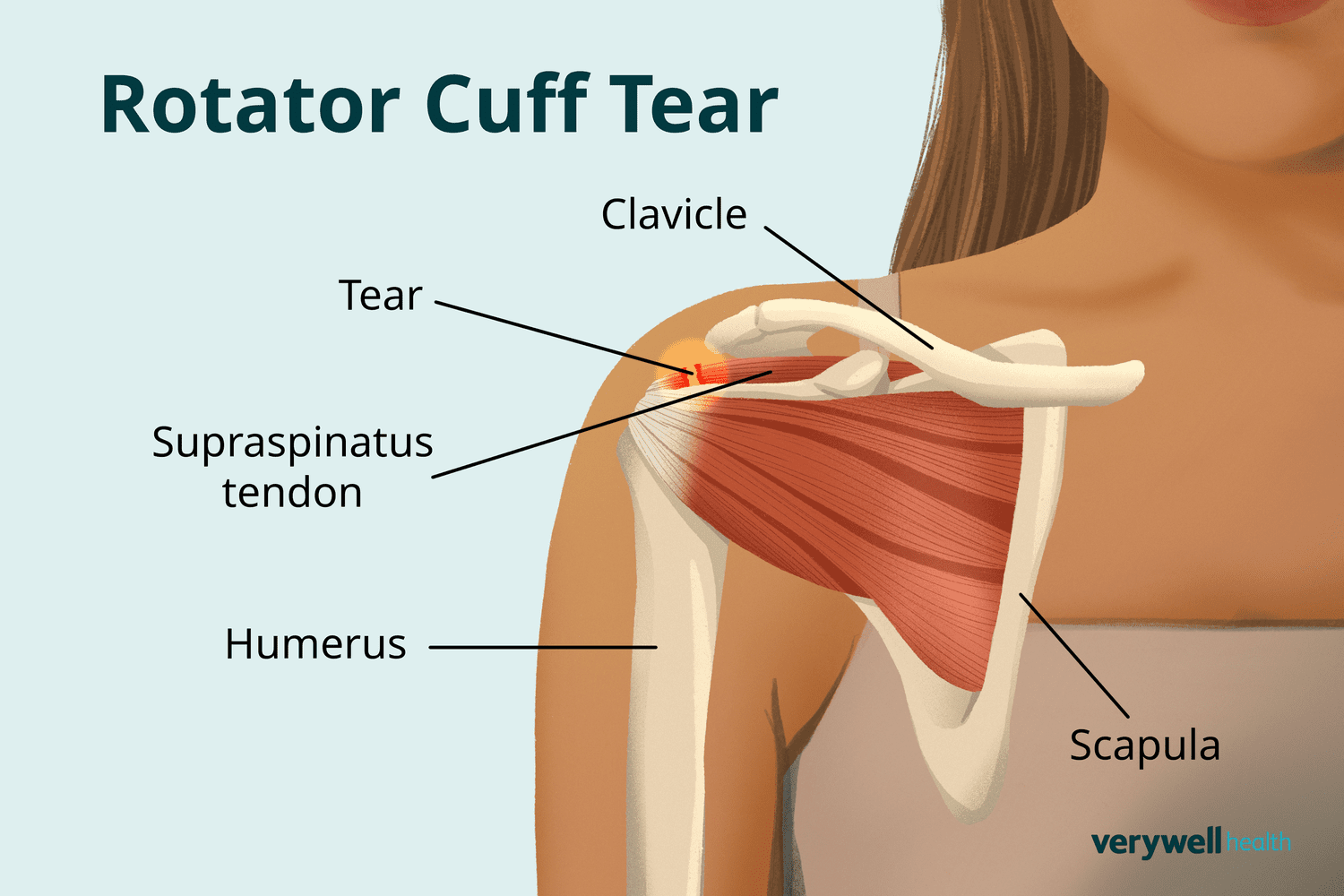 Deep Shoulder Pain