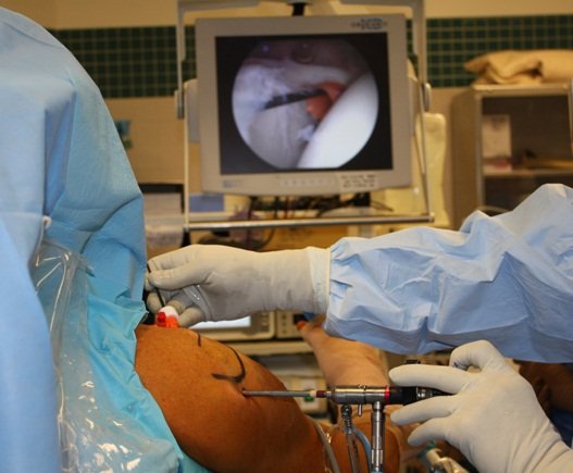 Shoulder Arthroscopy