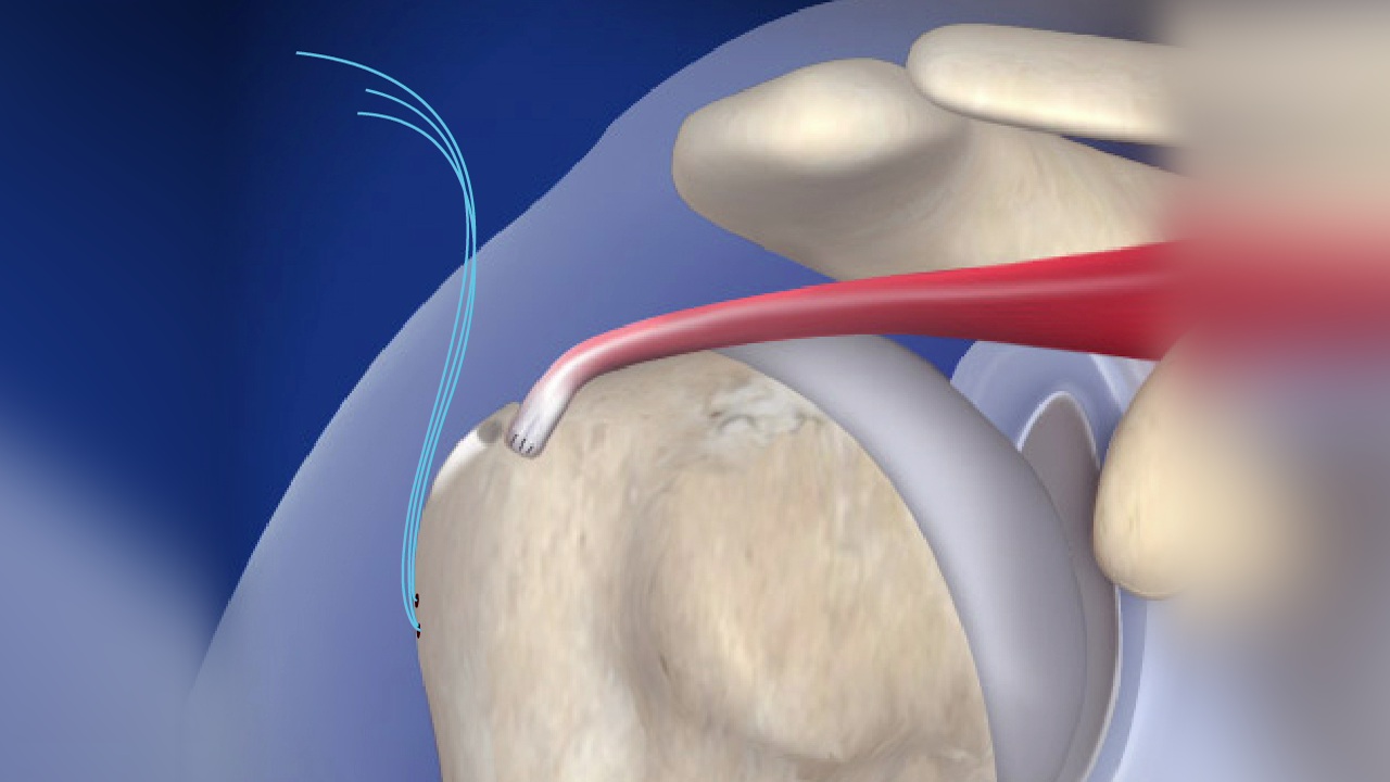 Arthroscopic Tendon Surgery