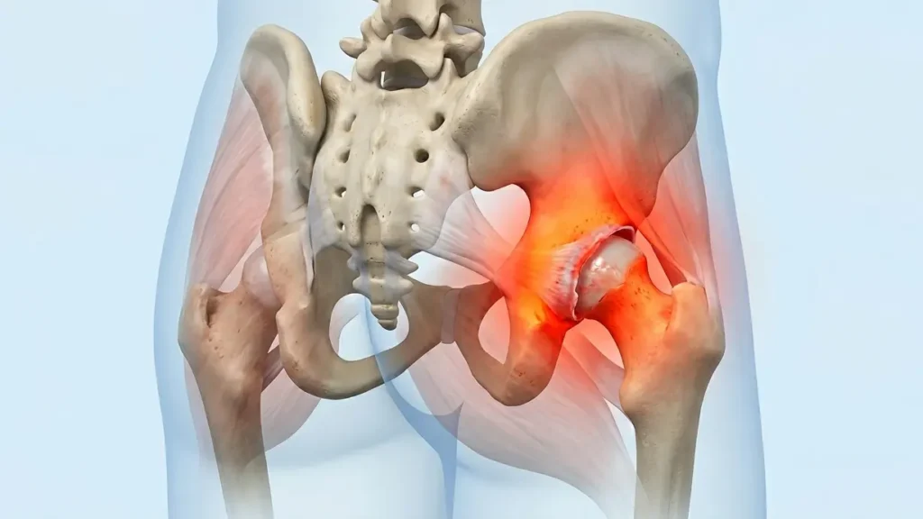 What is Hip Joint Inflammation