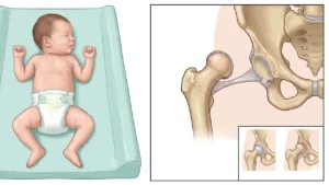 congenital hip dislocation radiology