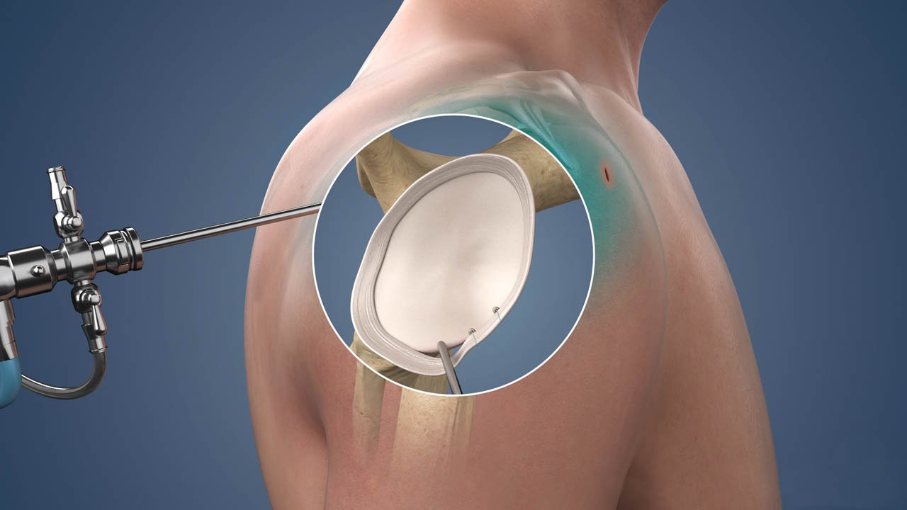 Shoulder Stabilization