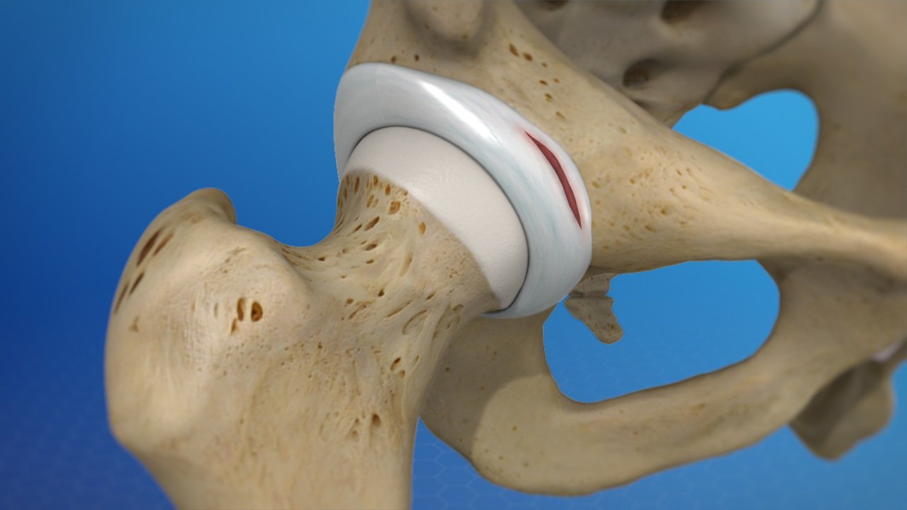 Knee Arthritis