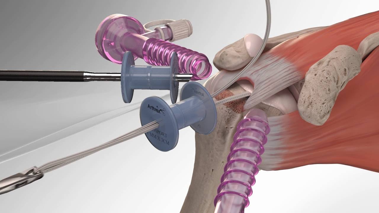 Arthroscopic Rotator Cuff Repair Surgery