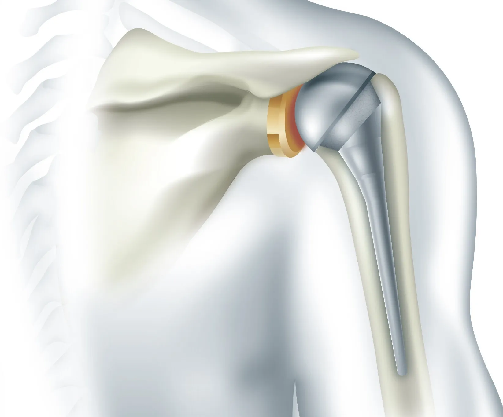 Shoulder Replacement
