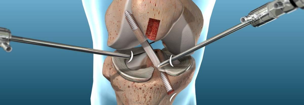 ACL Reconstruction Surgery