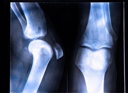 ACL Anatomy Tear