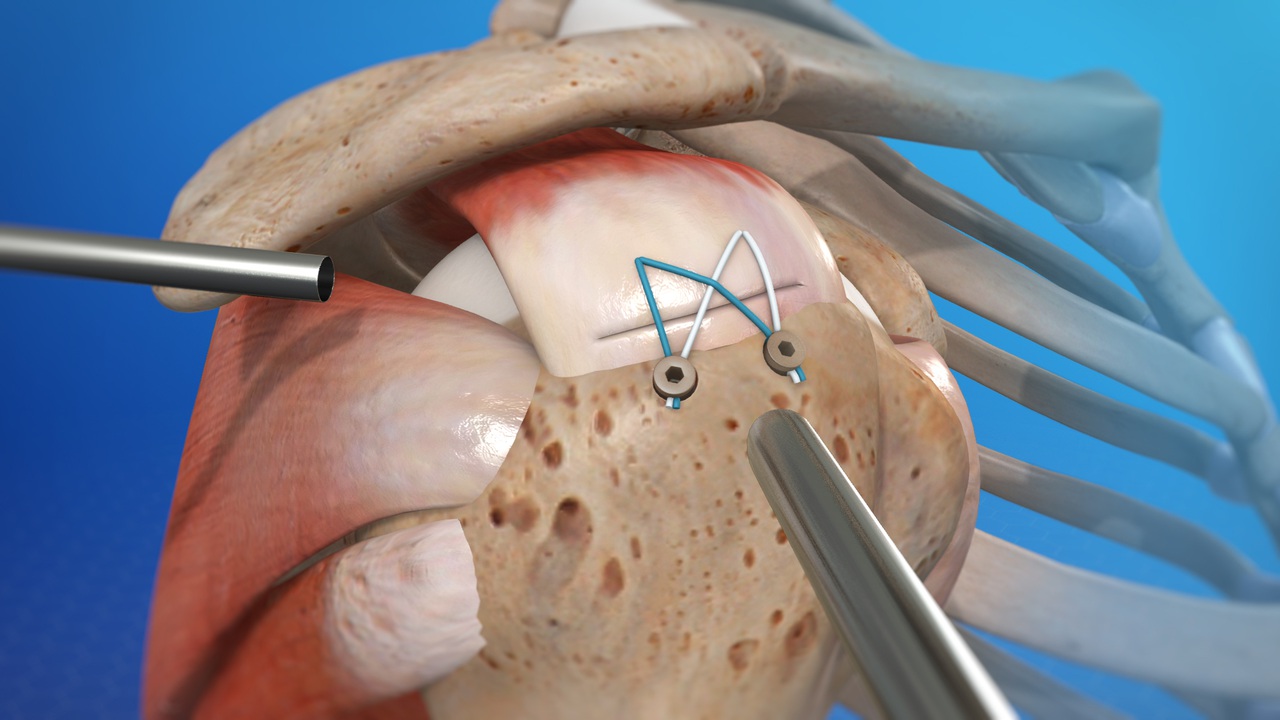 Arthroscopic shoulder and labral treatment planning