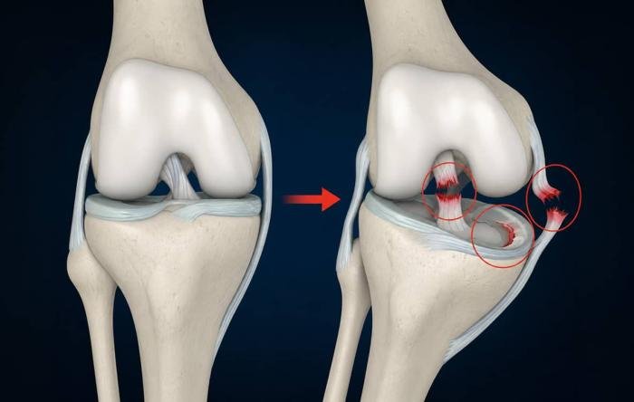 Digital Knee Illustration