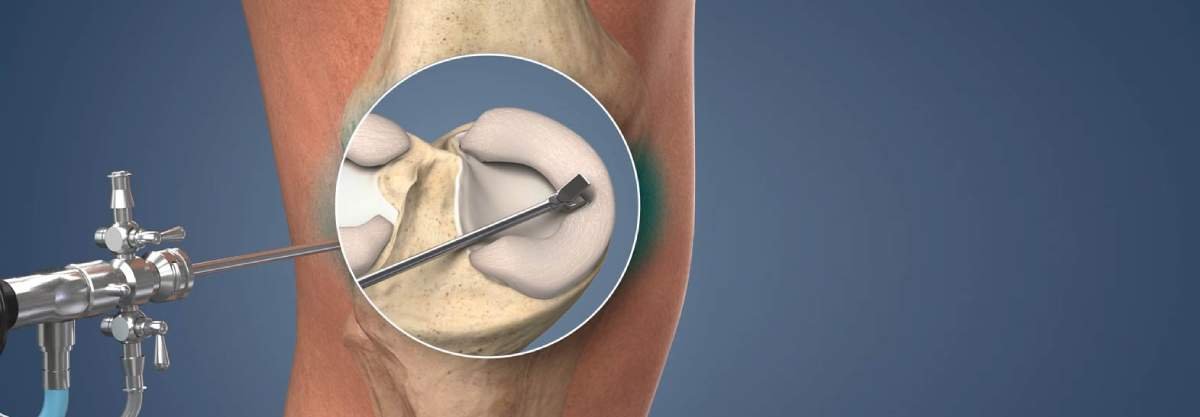 Meniscus Repair Suture