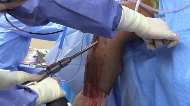 Multi-Ligament Knee Injury high-energy trauma presentation