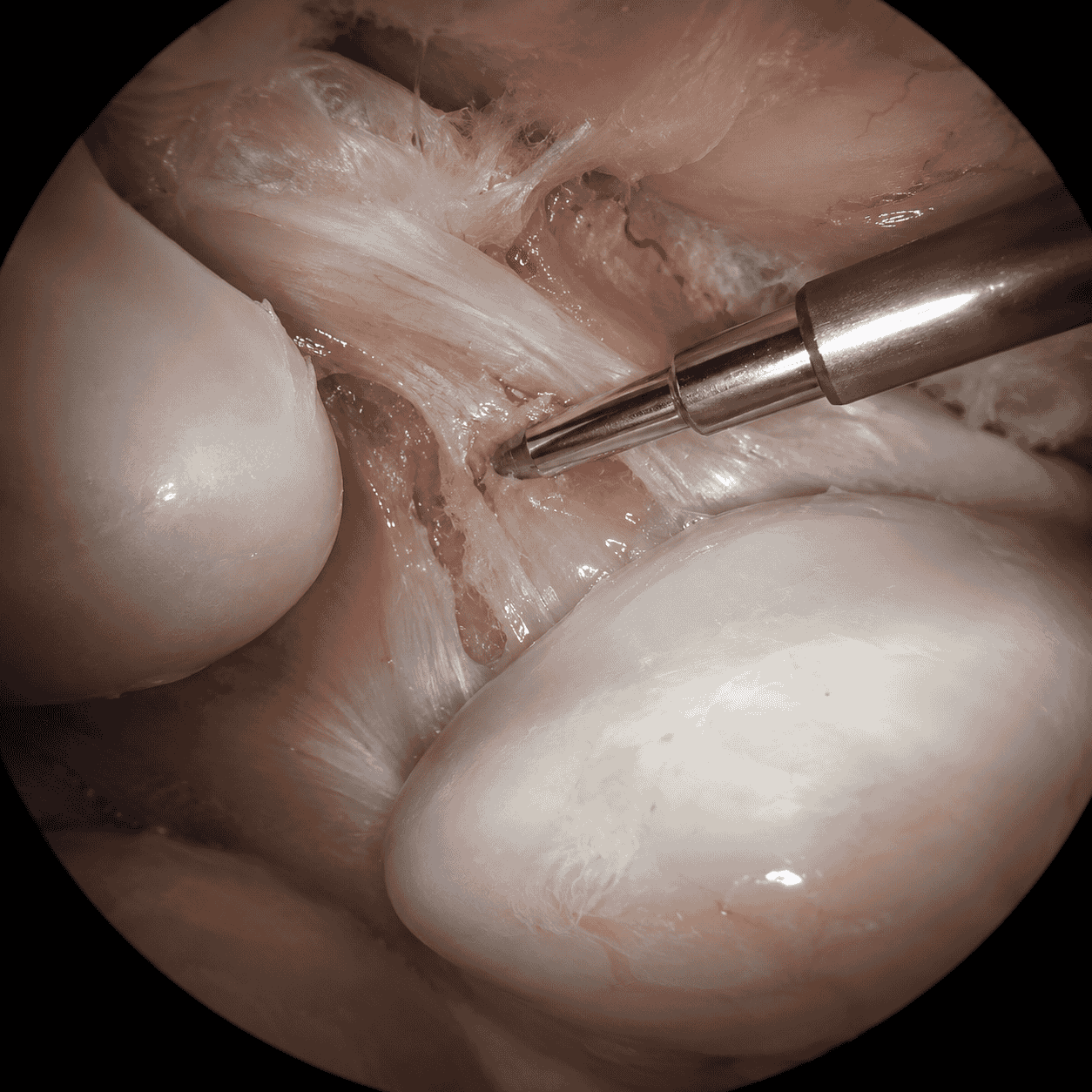 AC Joint Arthritis Treatment