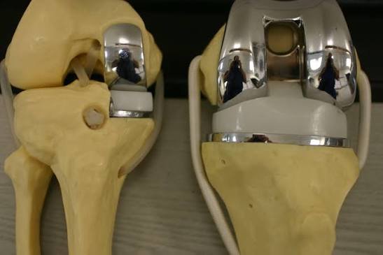 Knee implant imaging and planning