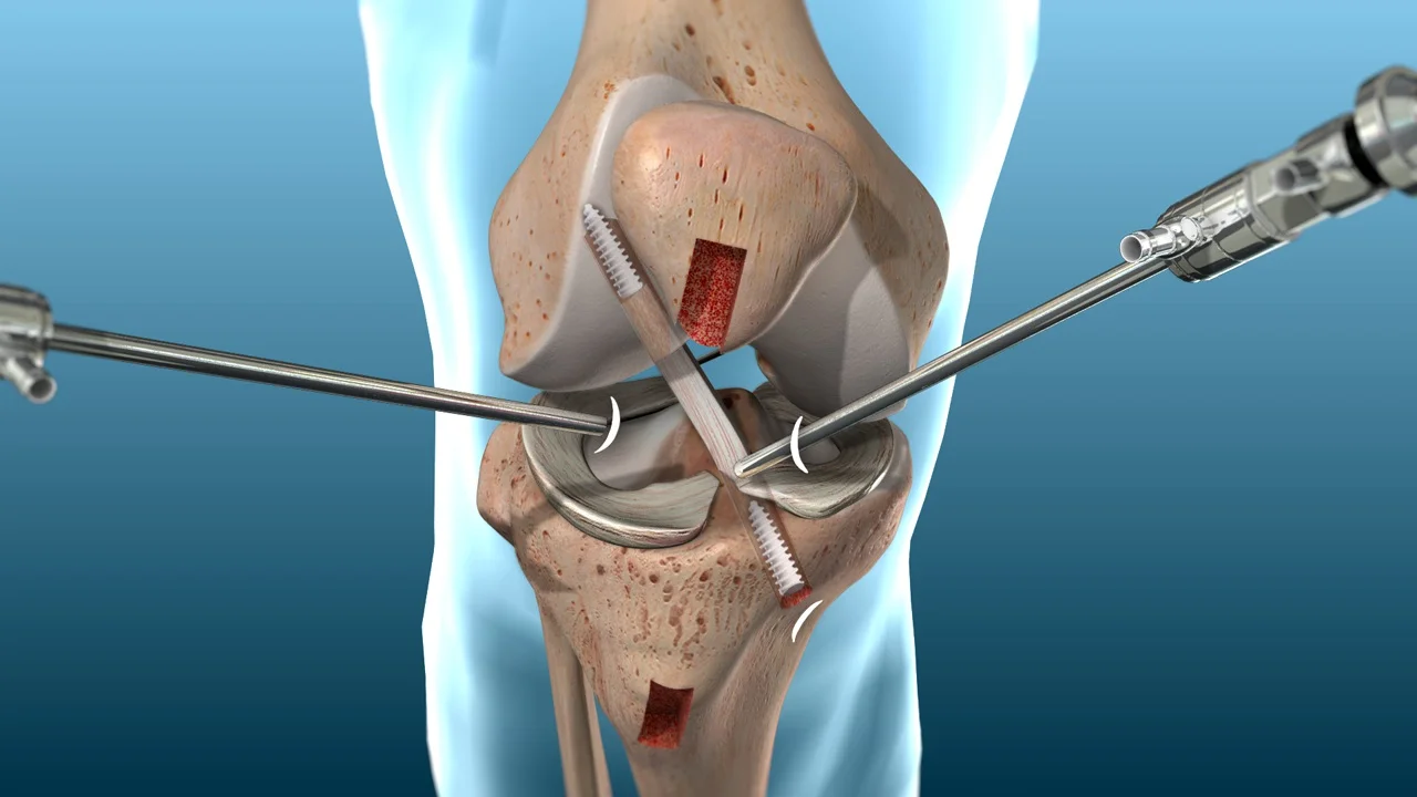 Arthroscopic ACL reconstruction surgical visualization