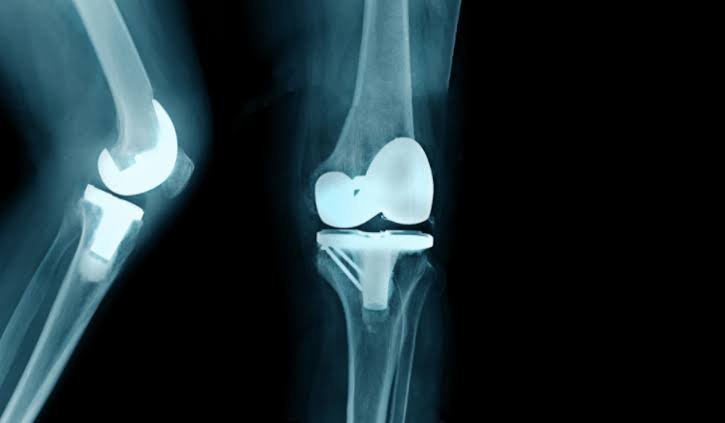 Partial knee replacement and knee anatomy assessment