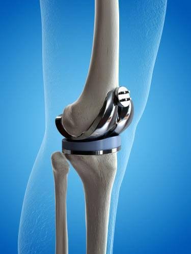 Total knee replacement surgery visualization