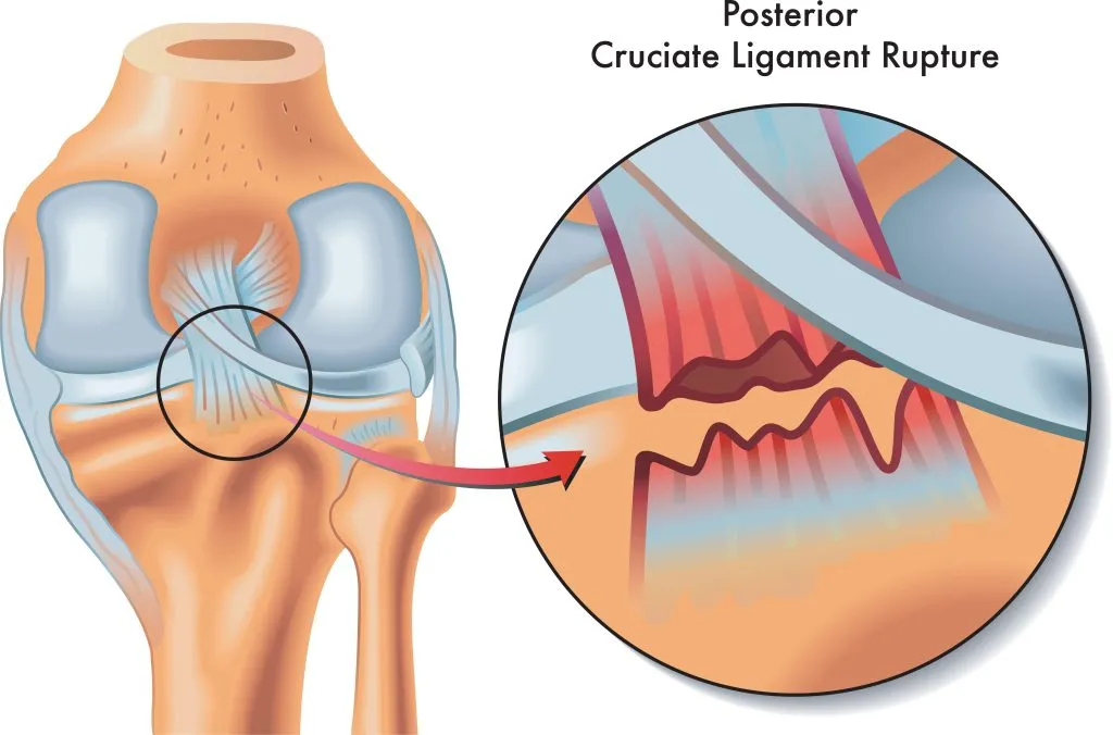 PCL Tear (Posterior Cruciate Ligament) diagnostic visual