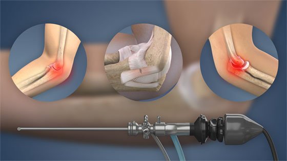 High-definition arthroscopy equipment used for minimally invasive orthopedic surgery