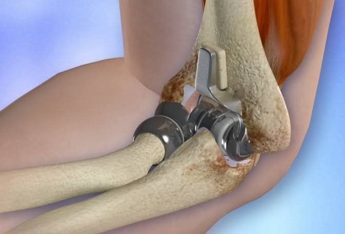 Pre-operative orthopedic surgical planning technology